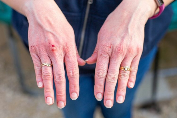 How a common skin virus can flip a switch to cancer
